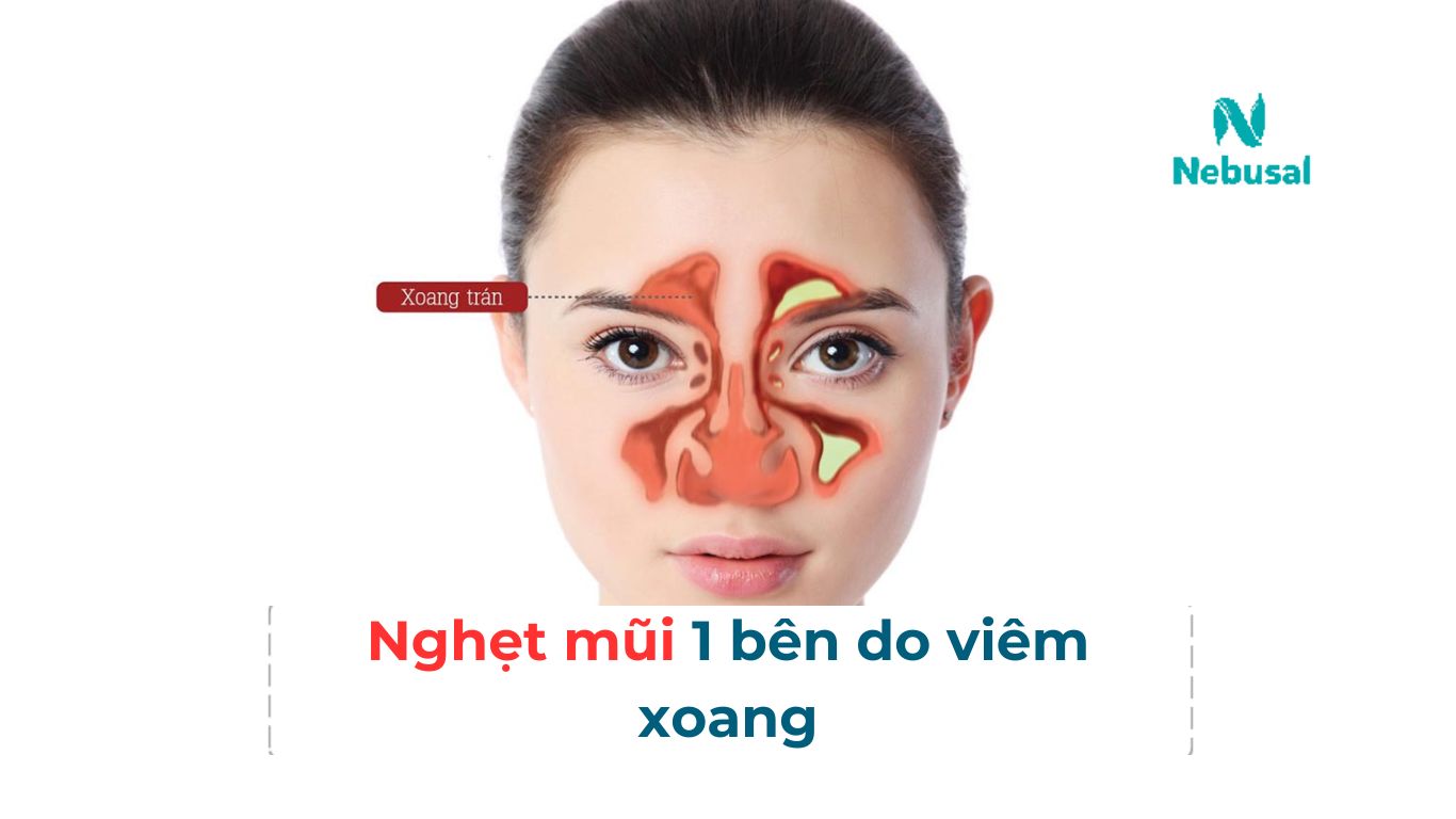 Bị nghẹt 1 bên mũi do viêm xoang