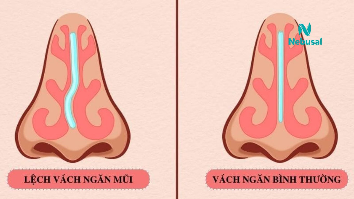 nghet-mui-1-ben